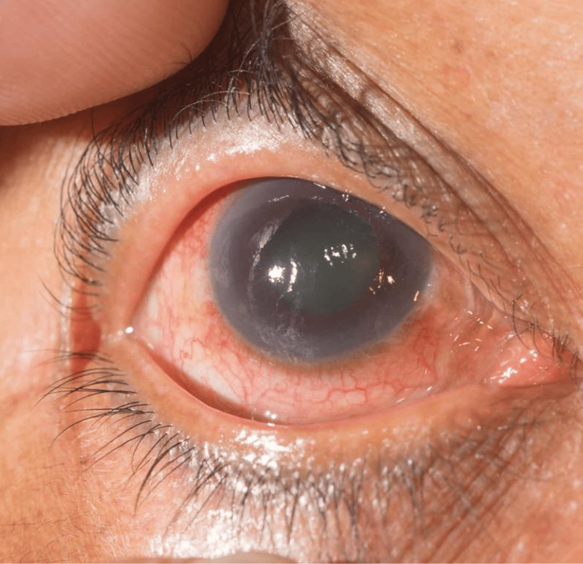Glaucoma: The Silent Thief of SightGlaucoma: The Silent Thief of Sight